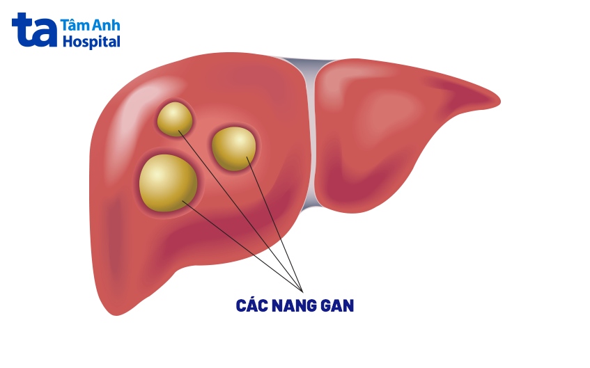 các nang ở gan