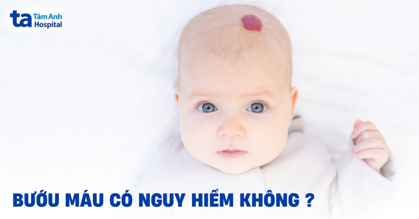 Bướu máu có nguy hiểm không