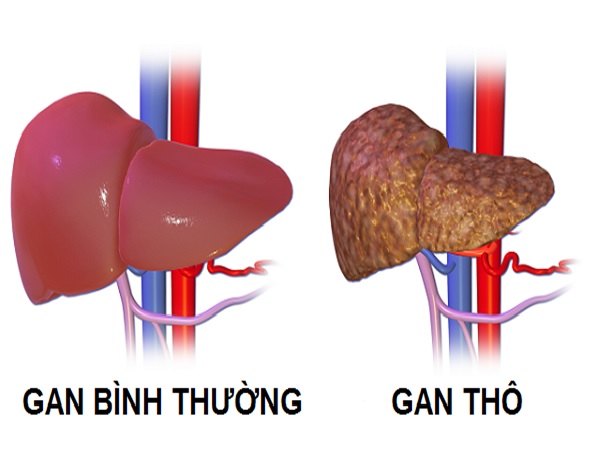 Gan thô có phục hồi được không