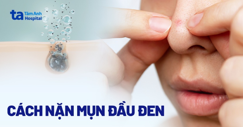 cách nặn mụn đầu đen