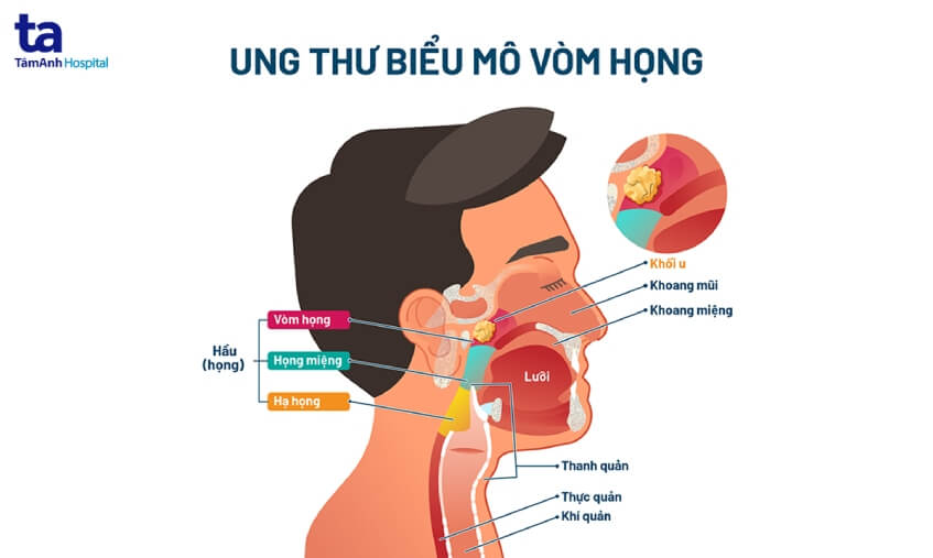 mô tả ung thư biểu mô vòm họng