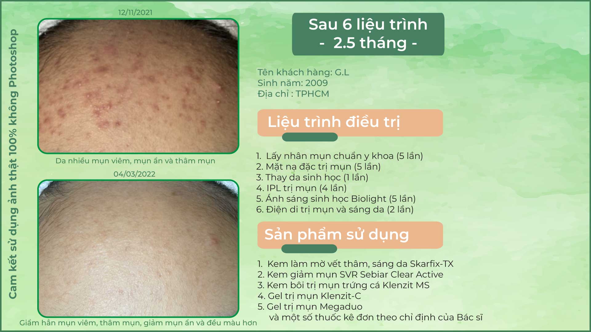 Ca lâm sàng mụn ẩn ở trán - Doctor Acnes