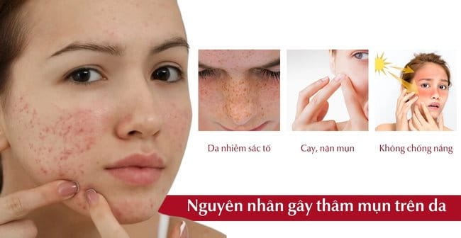 Nguyên nhân hình thành vết thâm mụn trên da