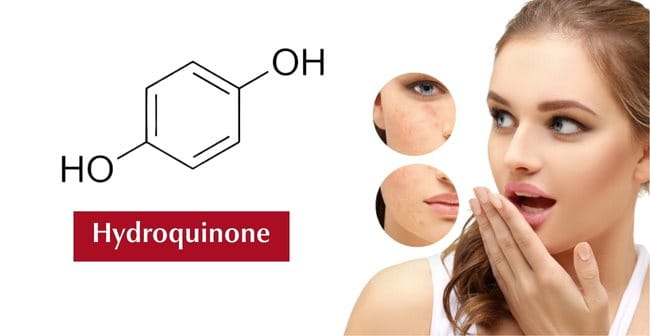 Cách trị thâm mụn cấp tốc sau 1 đêm với Hydroquinone