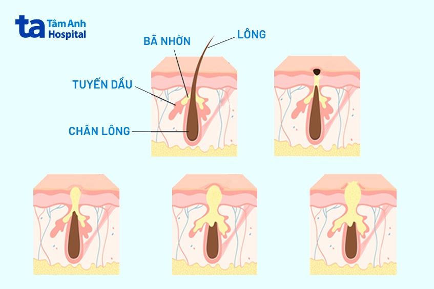 Tình trạng lỗ chân lông bít tắc, gây nổi mụn bọc