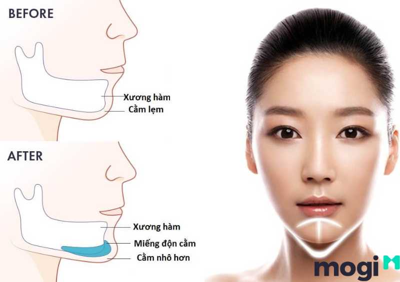 Sử dụng phương pháp độn cằm để khắc phục cằm tròn