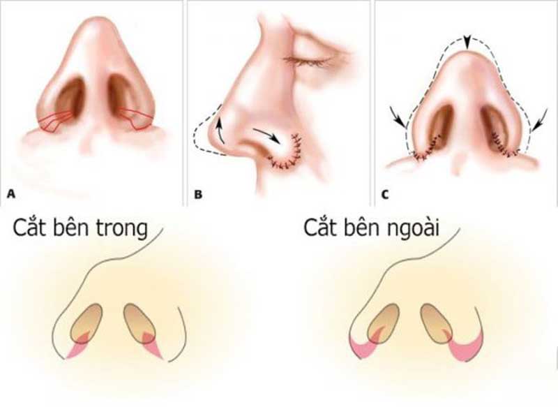 Cánh mũi to và dày thì phải làm sao để nhỏ xuống ?