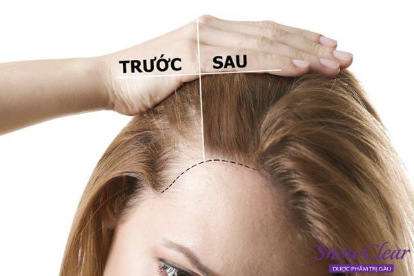 Sử dụng thêm dầu gội kích thích tóc mọc