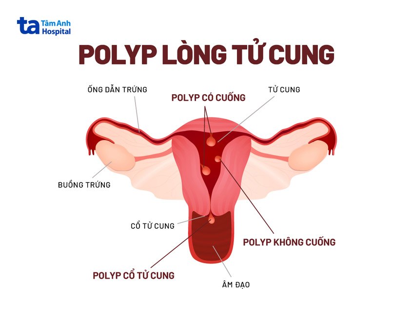 các vị trí xuất hiện polyp tử cung