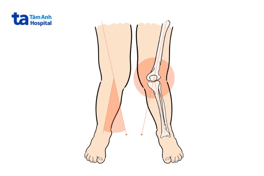 căn bệnh có thể tự khỏi khi trẻ lớn lên