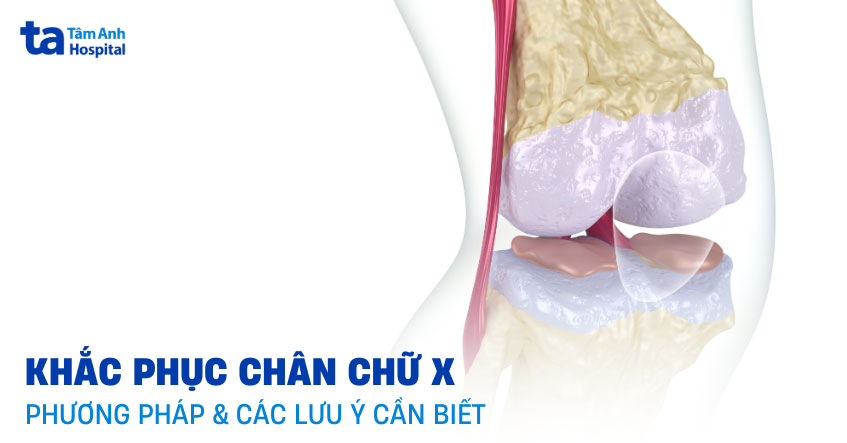 khắc phục chân chữ x