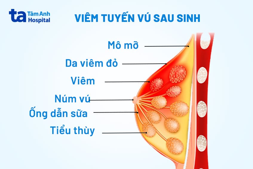 u vú ở phụ nữ cho con bú