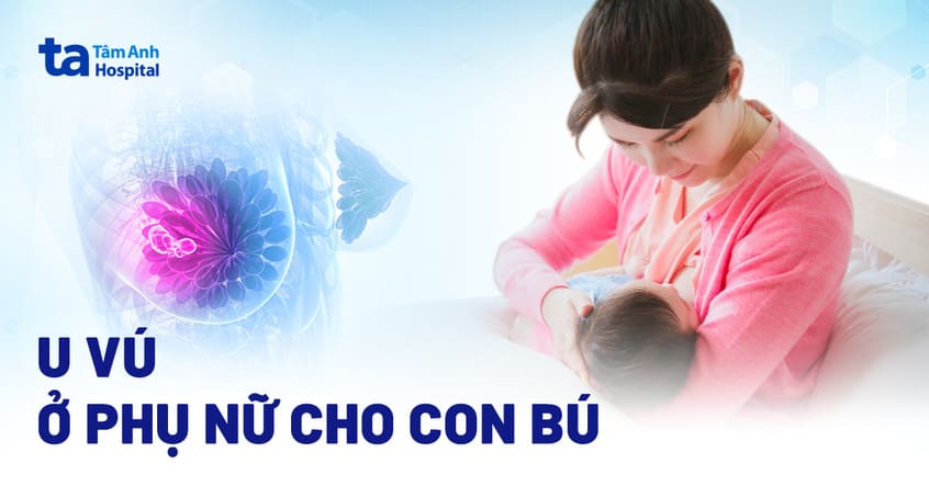 u vú ở phụ nữ đang cho con bú