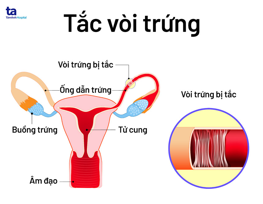 nguyên nhân do tắc vòi trứng