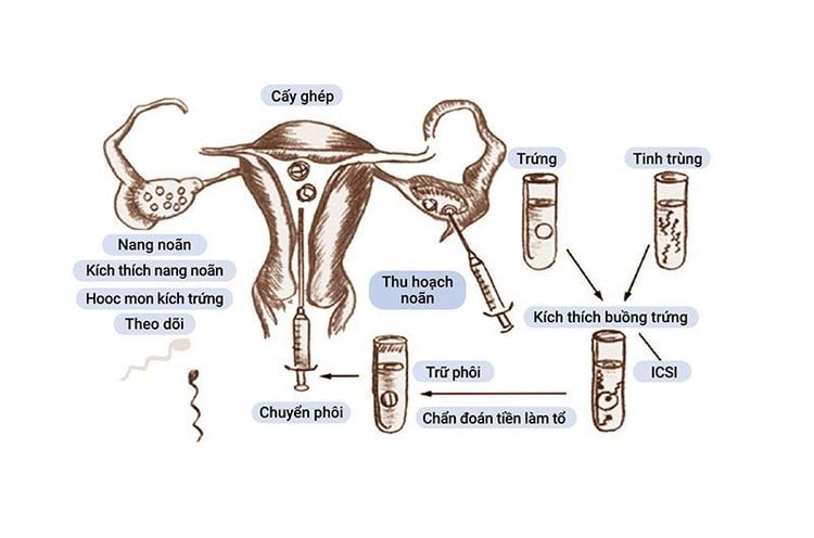 Các bước thụ tinh trong ống nghiệm (IVF)