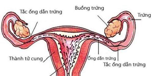 Trường hợp tắc ống dẫn trứng cần phẫu thuật điều trị hiếm muộn