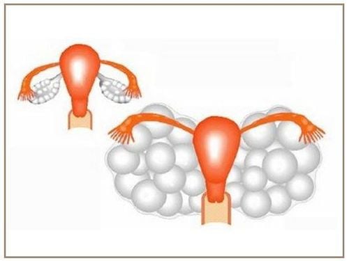 Hội chứng quá kích buồng trứng (OHSS)