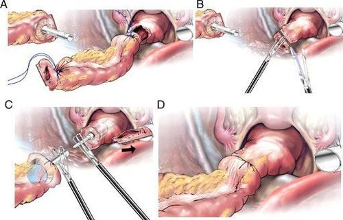 Kỹ thuật cắt đại tràng sigma nội soi toàn bộ