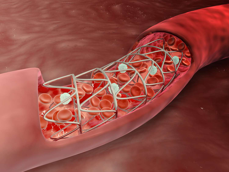 Chi phí đặt stent mạch vành có mắc không? 3