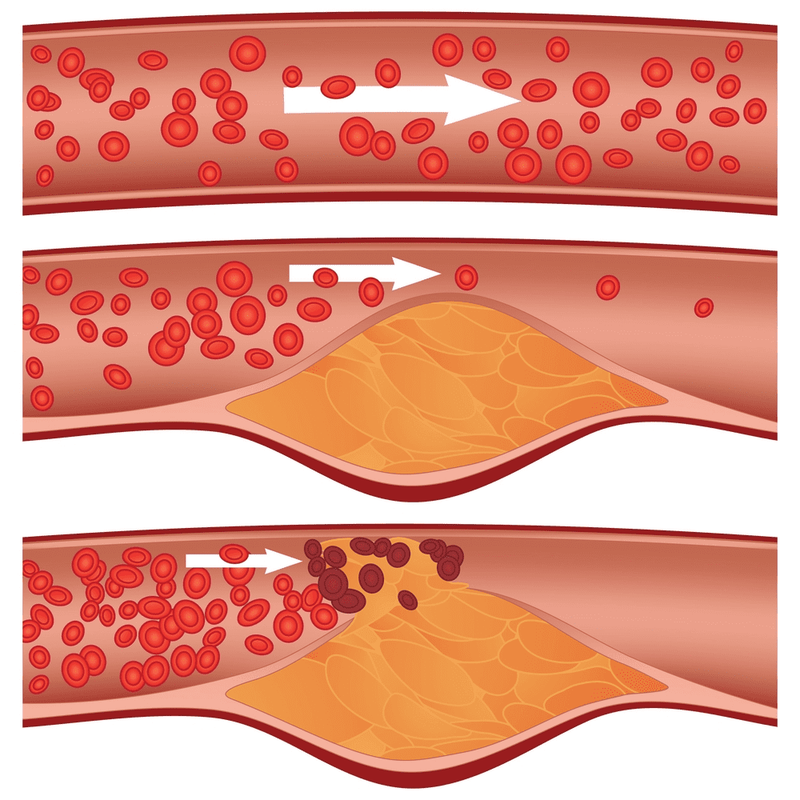 Chi phí đặt stent mạch vành có mắc không? 4