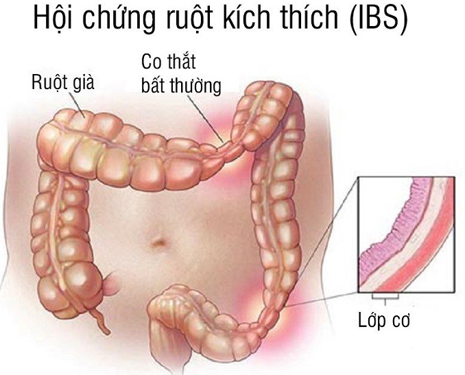 Mô phỏng hội chứng ruột kích thích