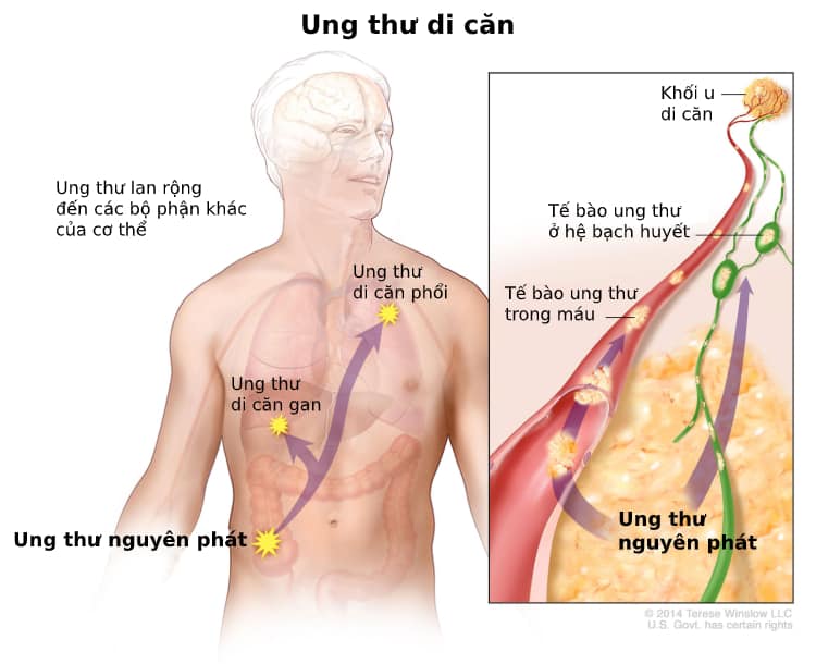 ung thư di căn 1