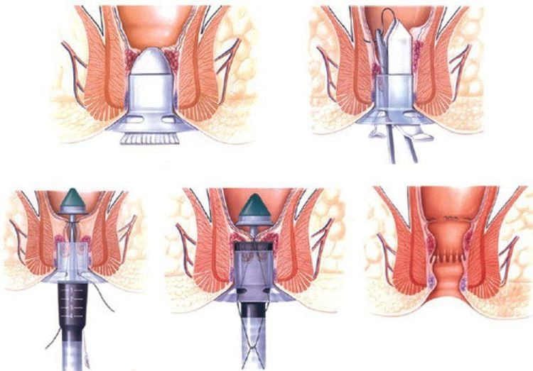 Các phương pháp phổ biến điều trị bệnh trĩ