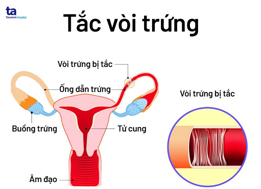 hiếm muộn nữ do tắc vòi trứng