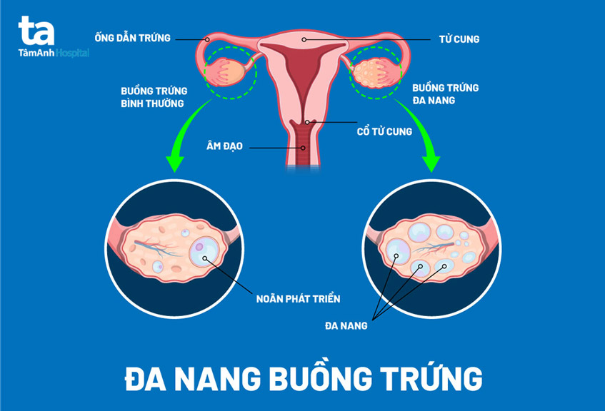 kháng isulin và béo phì gây đa nang buồng trứng