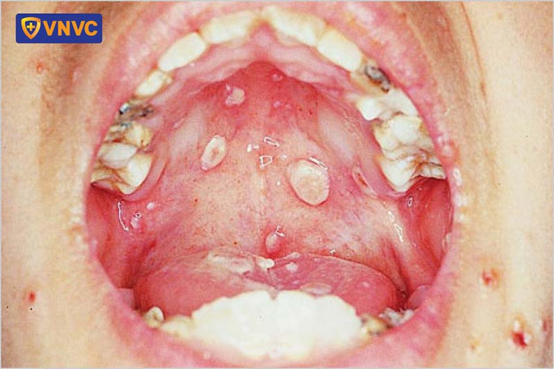 hình ảnh thủy đậu mọc trong miệng