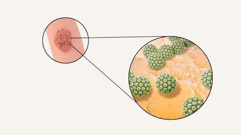 Người bệnh bị u nhú do HPV có nguy cơ cao mắc bệnh ung thư amidan