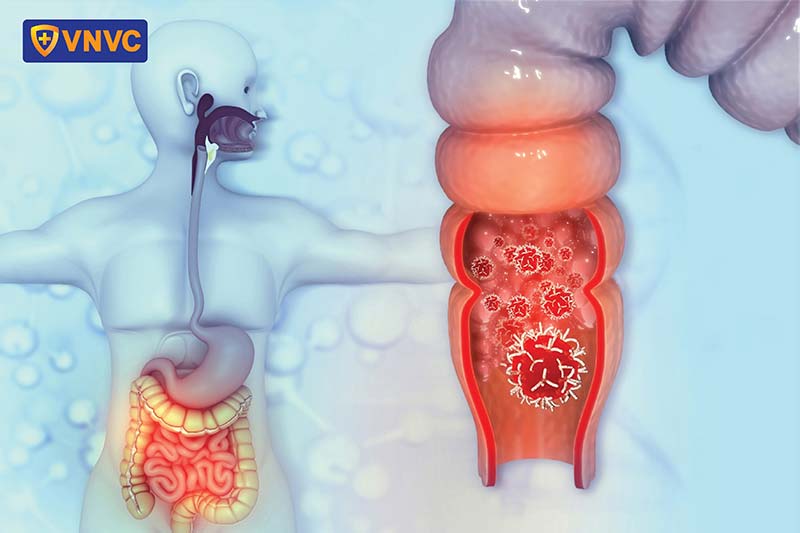 hpv gây ung thư hậu môn