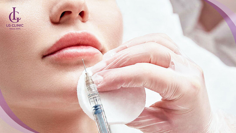 Tiêm filler tạo hình dáng môi đẹp