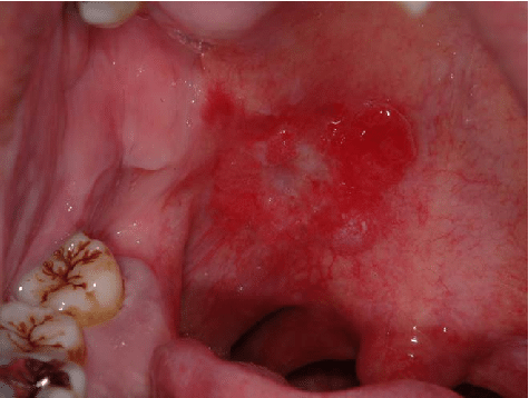 Soft palate là gì? Cấu tạo và chức năng của soft palate 4