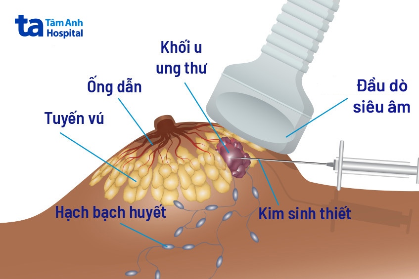 khối u ở ngực