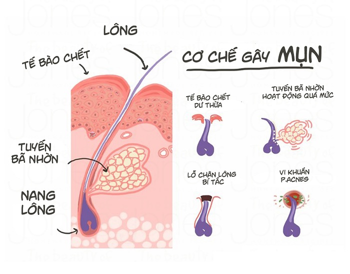 Bật mí 9 cách trị mụn tại nhà đơn giản, dễ thực hiện