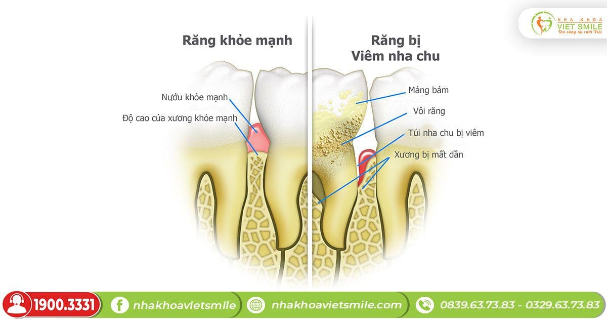 tác hại của cao răng