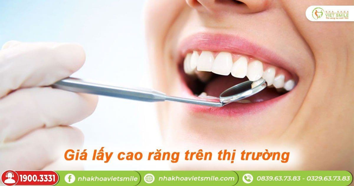 Giá lấy cao răng trên thị trường