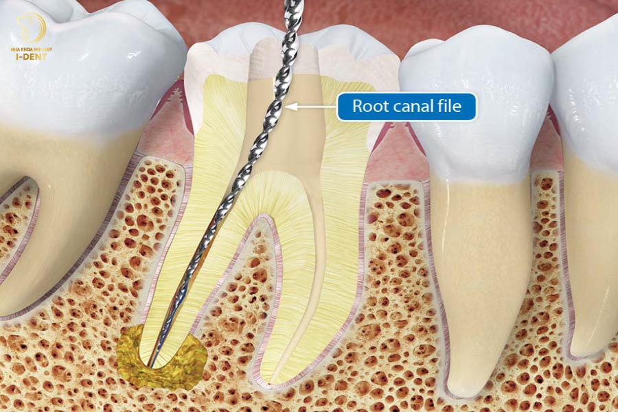 triệt tủy răng giá bao nhiêu - Răng cần được lấy tủy trước khi điều trị viêm nhiễm