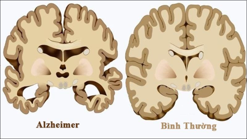 Thiamine giúp cải thiện chức năng nhận thức của bệnh nhân mắc bệnh Alzheimer