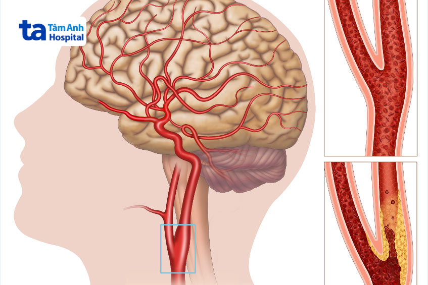 Động mạch cảnh bị hẹp làm giảm lượng máu lên não, nguy cơ gây đột quỵ