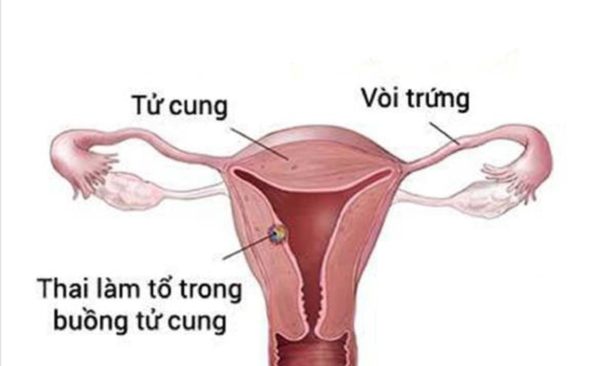 Dấu hiệu thai vào tử cung