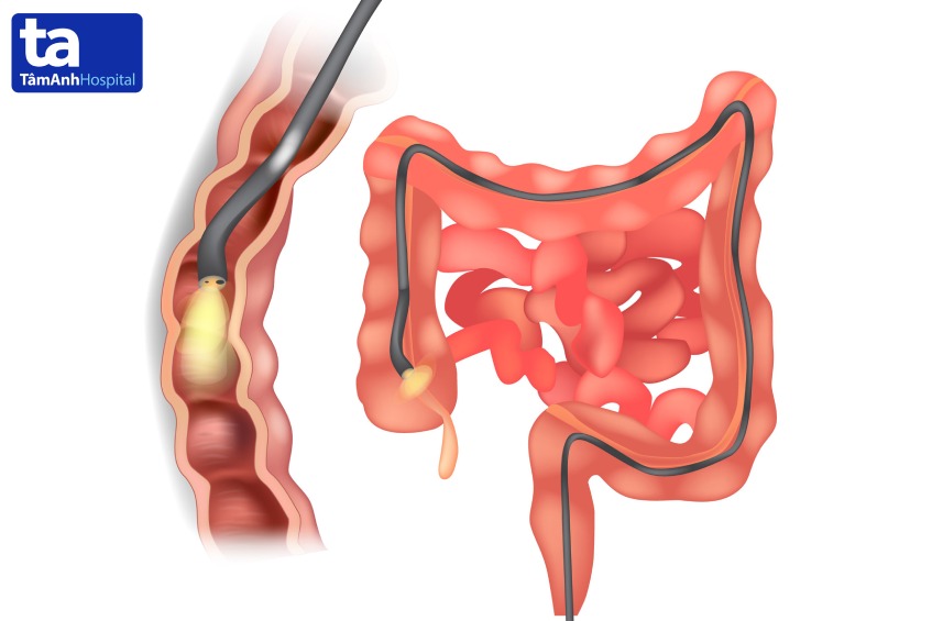 nội soi đại tràng gây mê