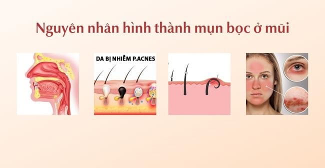 Nguyên nhân gây nên mụn bọc ở mũi