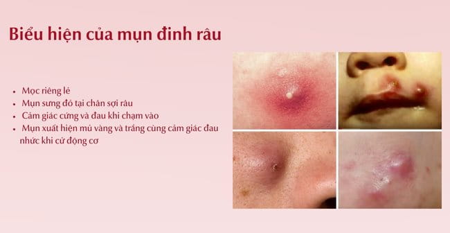 Biểu hiện của mụn đinh râu