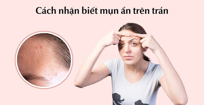 Cách nhận biết mụn ẩn trên trán