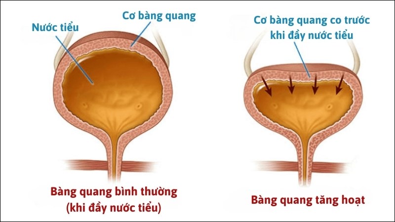 Bàng quang tăng hoạt làm giảm khả năng kiểm soát việc đi tiểu và dễ gây ra đái dầm