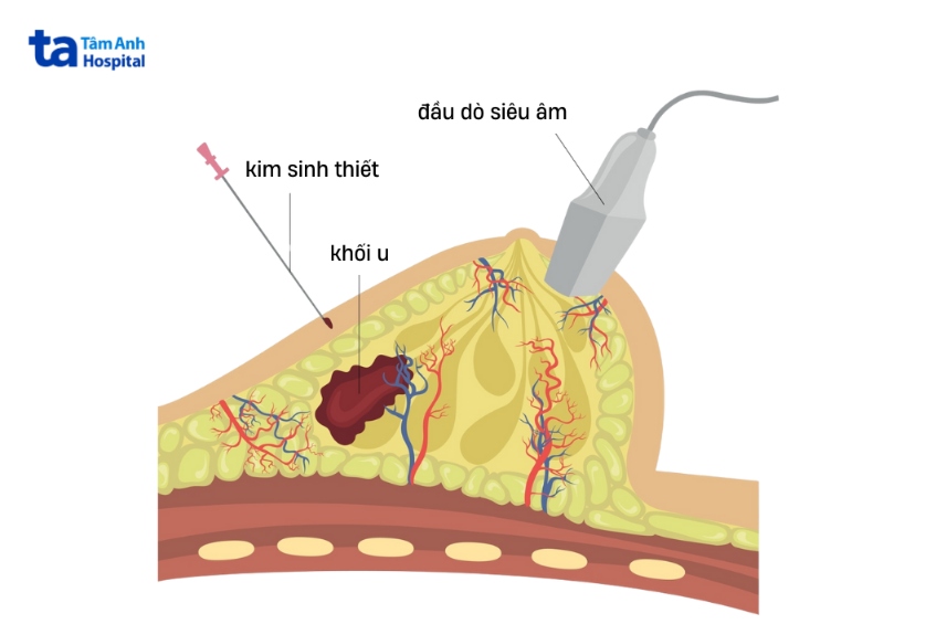 vú bị đau khi ấn vào