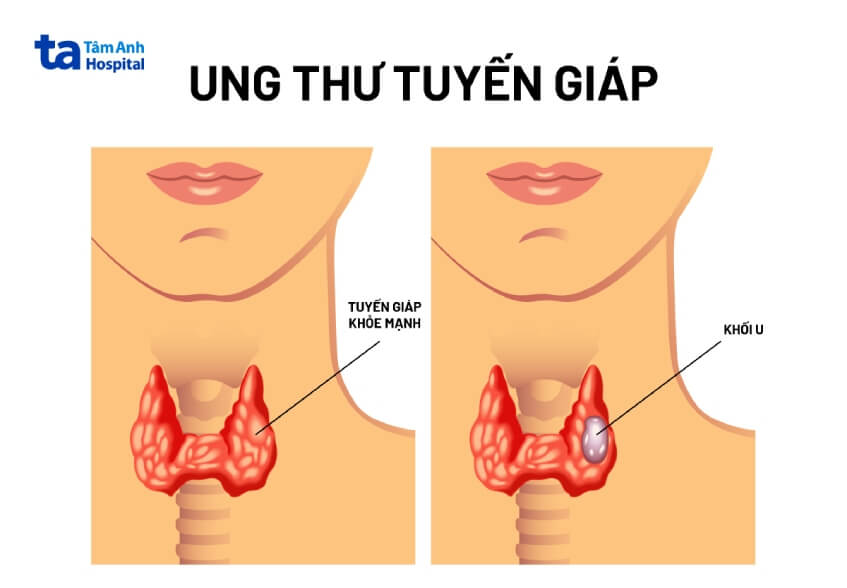 chẩn đoán ung thư tuyến giáp thể nang