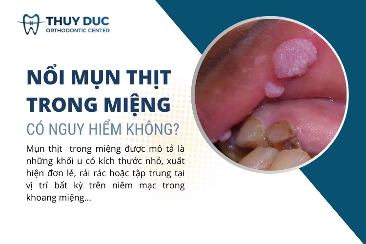 Nổi mụn thịt trong miệng không đau có nguy hiểm không? 1